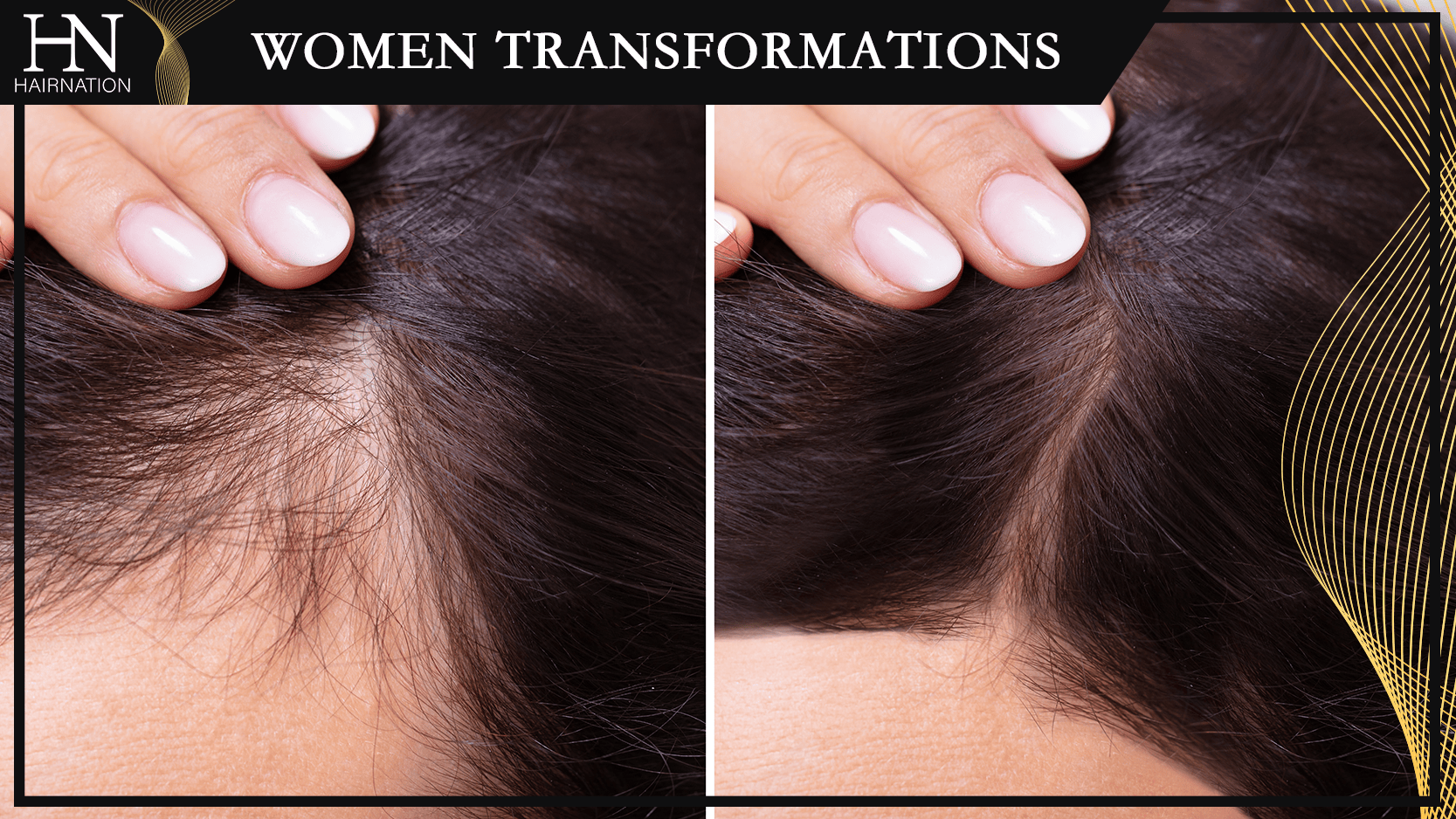 Women's Hair Loss Transformations