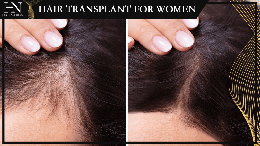 Hair Transplant For Women