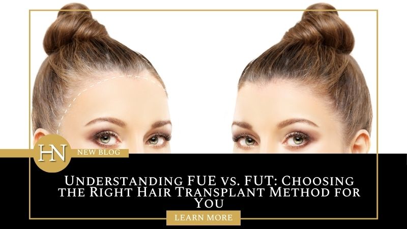 Understanding FUE vs. FUT: Choosing the Right Hair Transplant Method for You