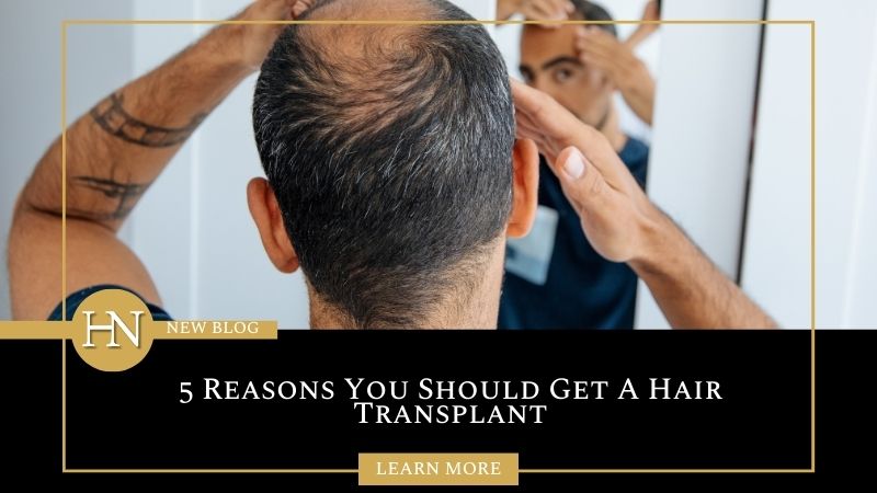 5 Reasons You Should Get A Hair Transplant