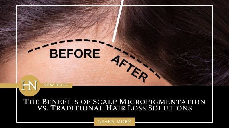 The Benefits of Scalp Micropigmentation vs. Traditional Hair Loss Solutions