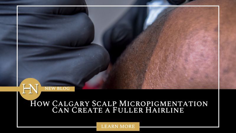 How Calgary Scalp Micropigmentation Can Create a Fuller Hairline