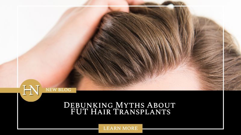 Vancouver FUT Treatment: Debunking Myths About FUT Hair Transplants