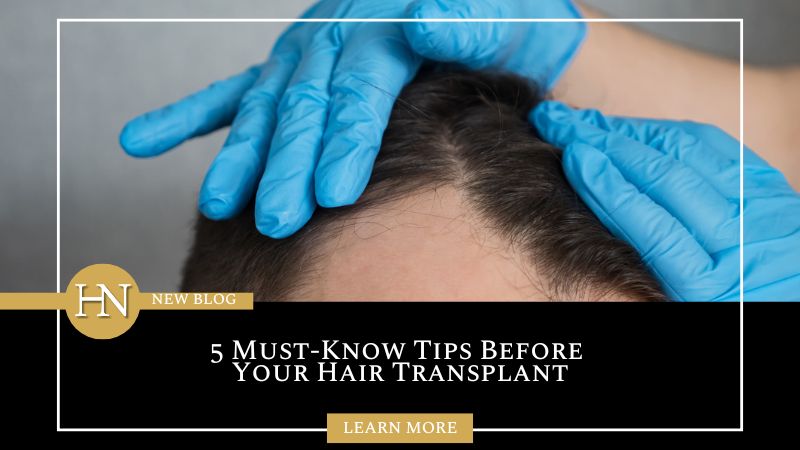 Edmonton Hair Transplant: 5 Must-Know Tips Before Your Hair Transplant