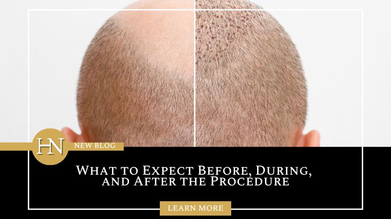 Hair Transplant in Vancouver: What to Expect Before, During, and After the Procedure