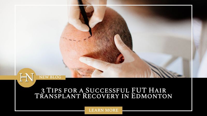 3 Tips for a Successful FUT Hair Transplant Recovery in Edmonton