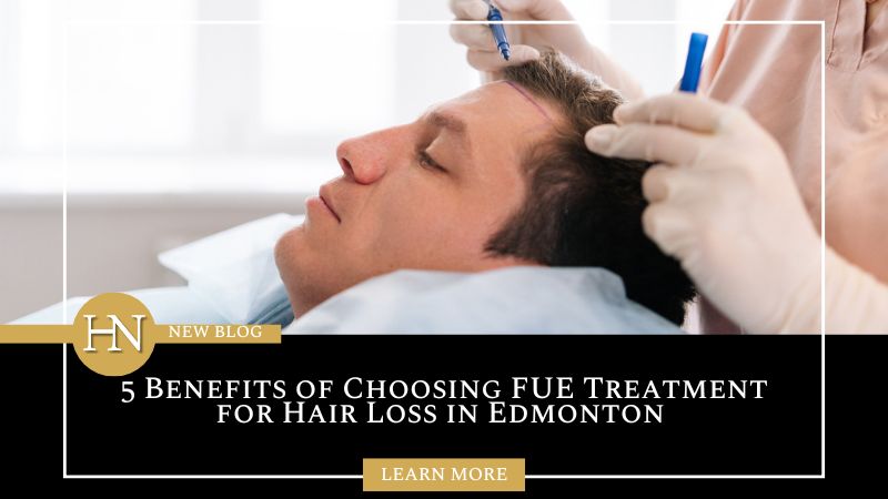 5 Benefits of Choosing FUE Treatment for Hair Loss in Edmonton 