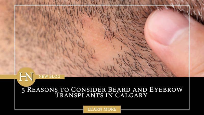 5 Reasons to Consider Beard and Eyebrow Transplants in Calgary