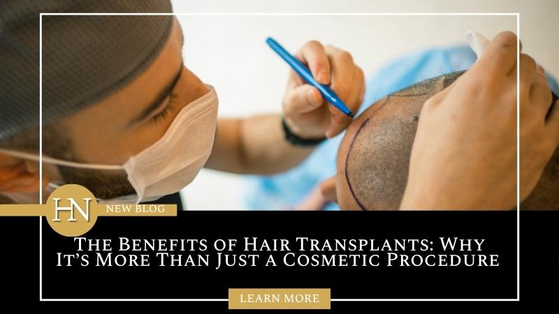 The Benefits of Hair Transplants: Why It’s More Than Just a Cosmetic Procedure