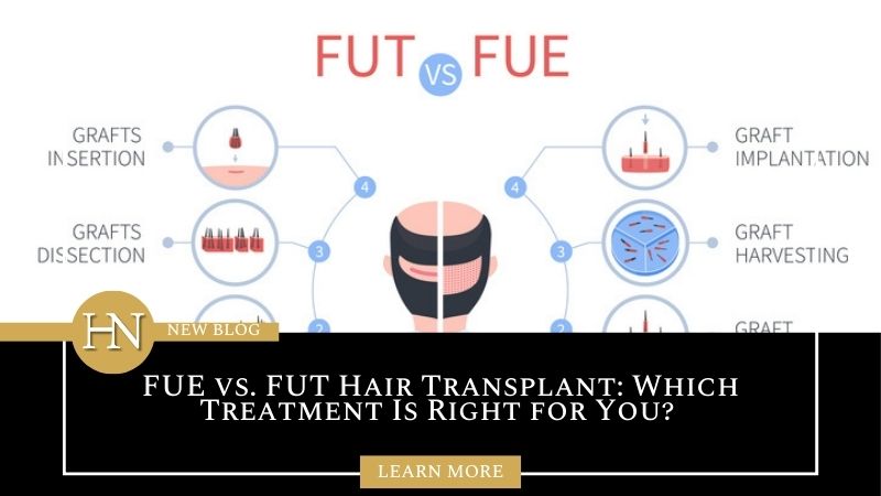 FUE vs. FUT Hair Transplant: Which Treatment Is Right for You?