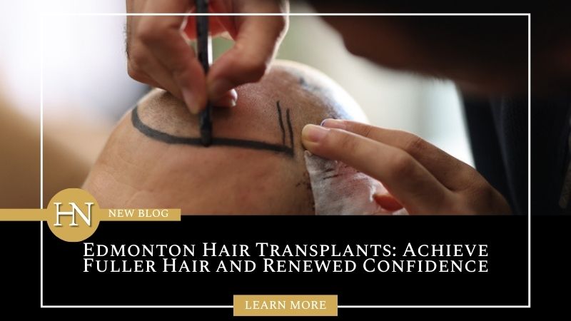 Edmonton Hair Transplants: Achieve Fuller Hair and Renewed Confidence