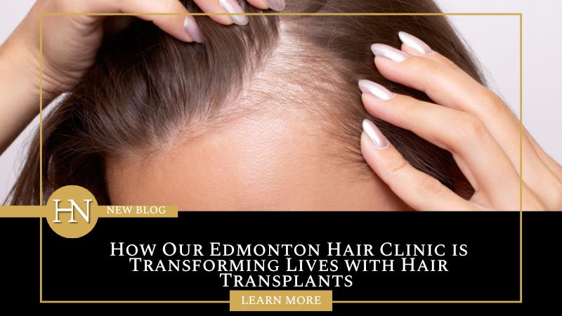 How Our Edmonton Hair Clinic is Transforming Lives with Hair Transplants 