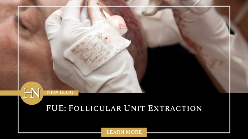 FUE: Follicular Unit Extraction In Calgary