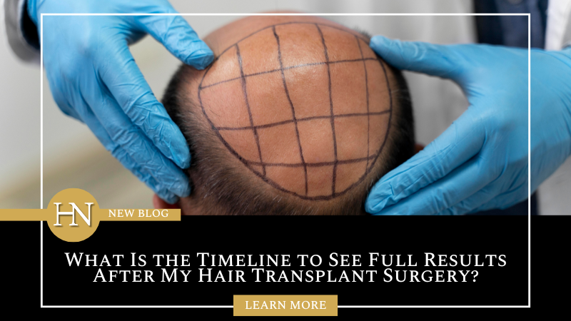 What Is the Timeline to See Full Results After My Hair Transplant Surgery?