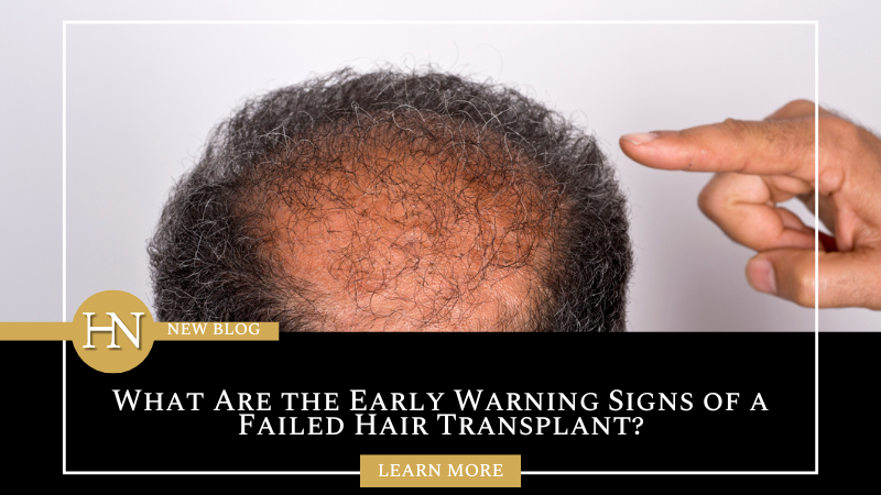 What Are the Early Warning Signs of a Failed Hair Transplant?