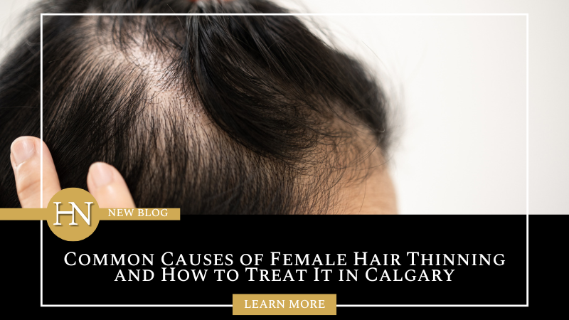 Common Causes of Female Hair Thinning and How to Treat It in Calgary