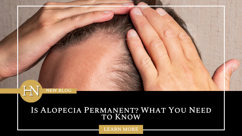 Is Alopecia Permanent? What You Need to Know