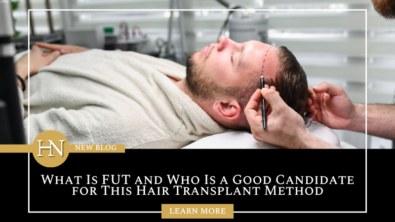 What Is FUT and Who Is a Good Candidate for This Hair Transplant Method