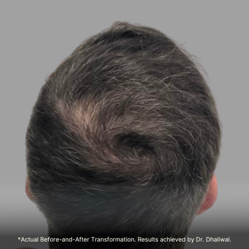 Set 5-HairNation-Before/After