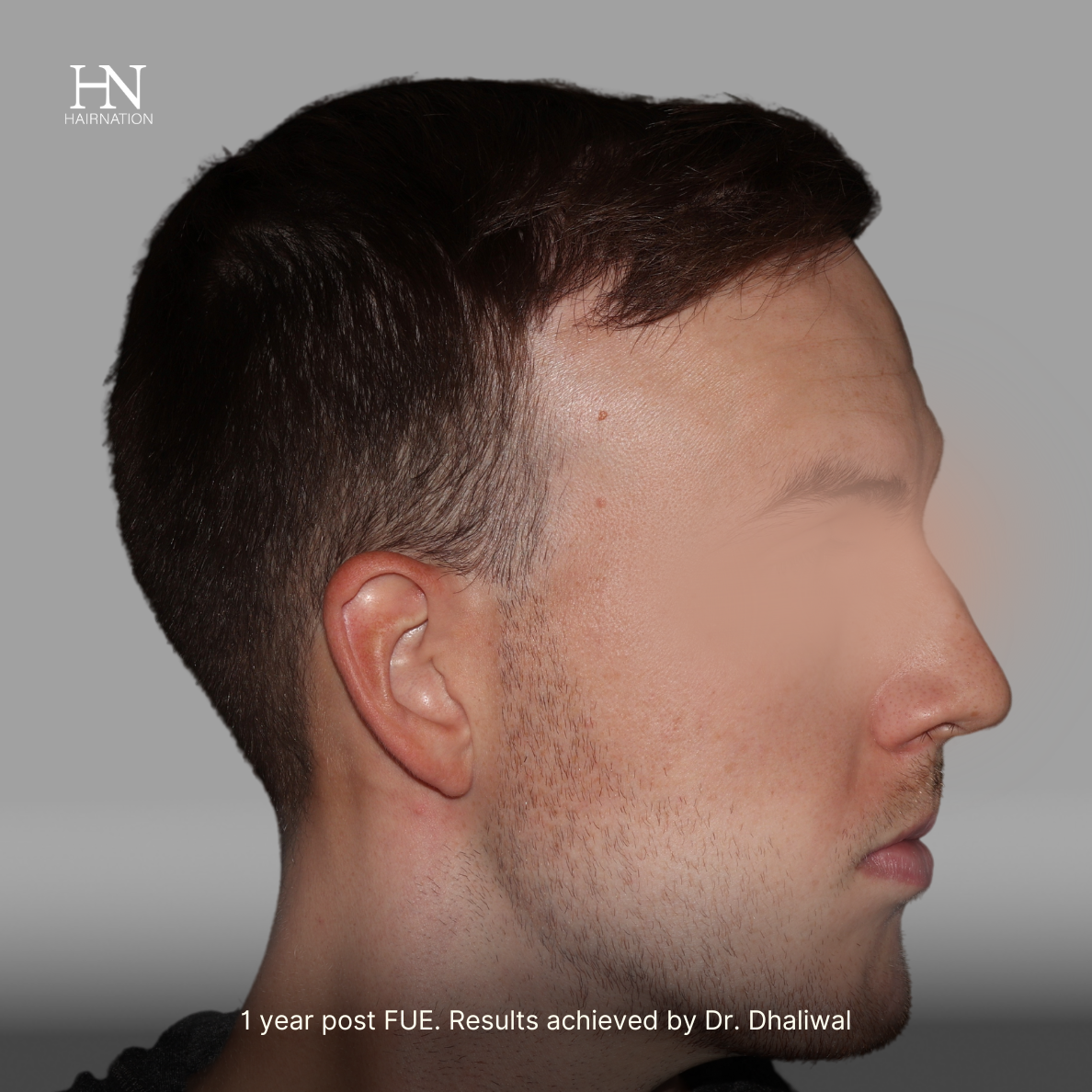 1 year post FUE - Before/After