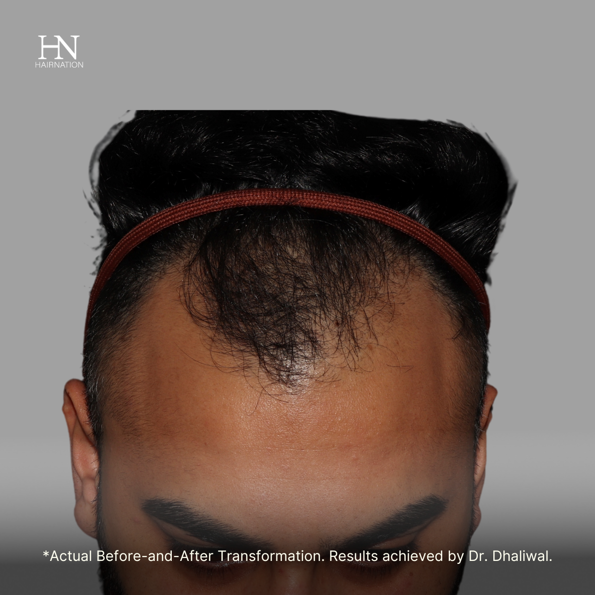 6 months  post FUE - Before/After
