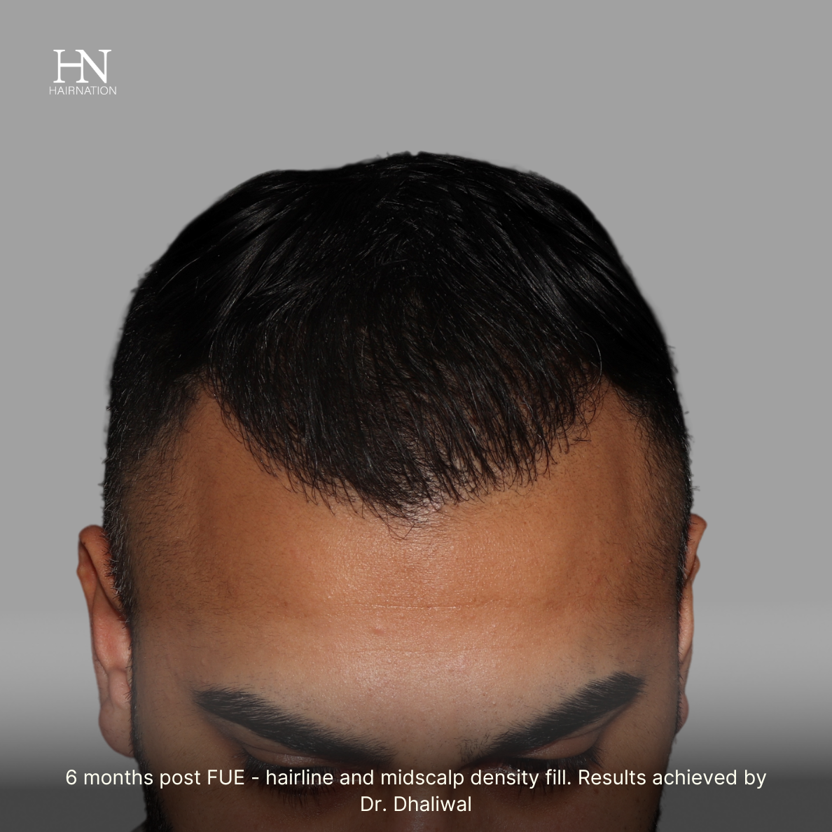 6 months  post FUE - Before/After