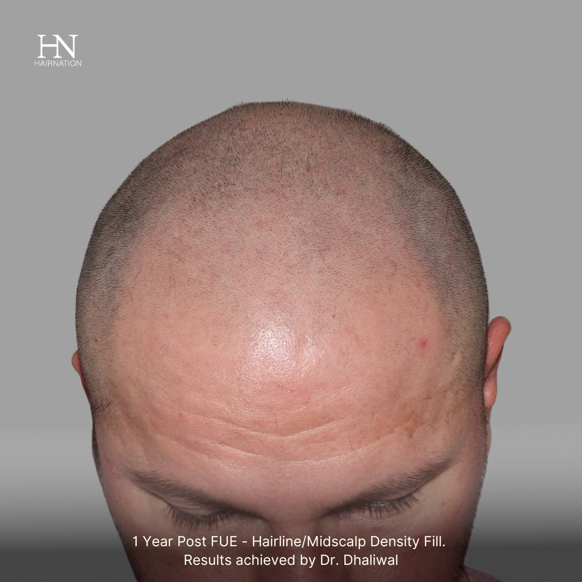 1 year post FUE - Before/After