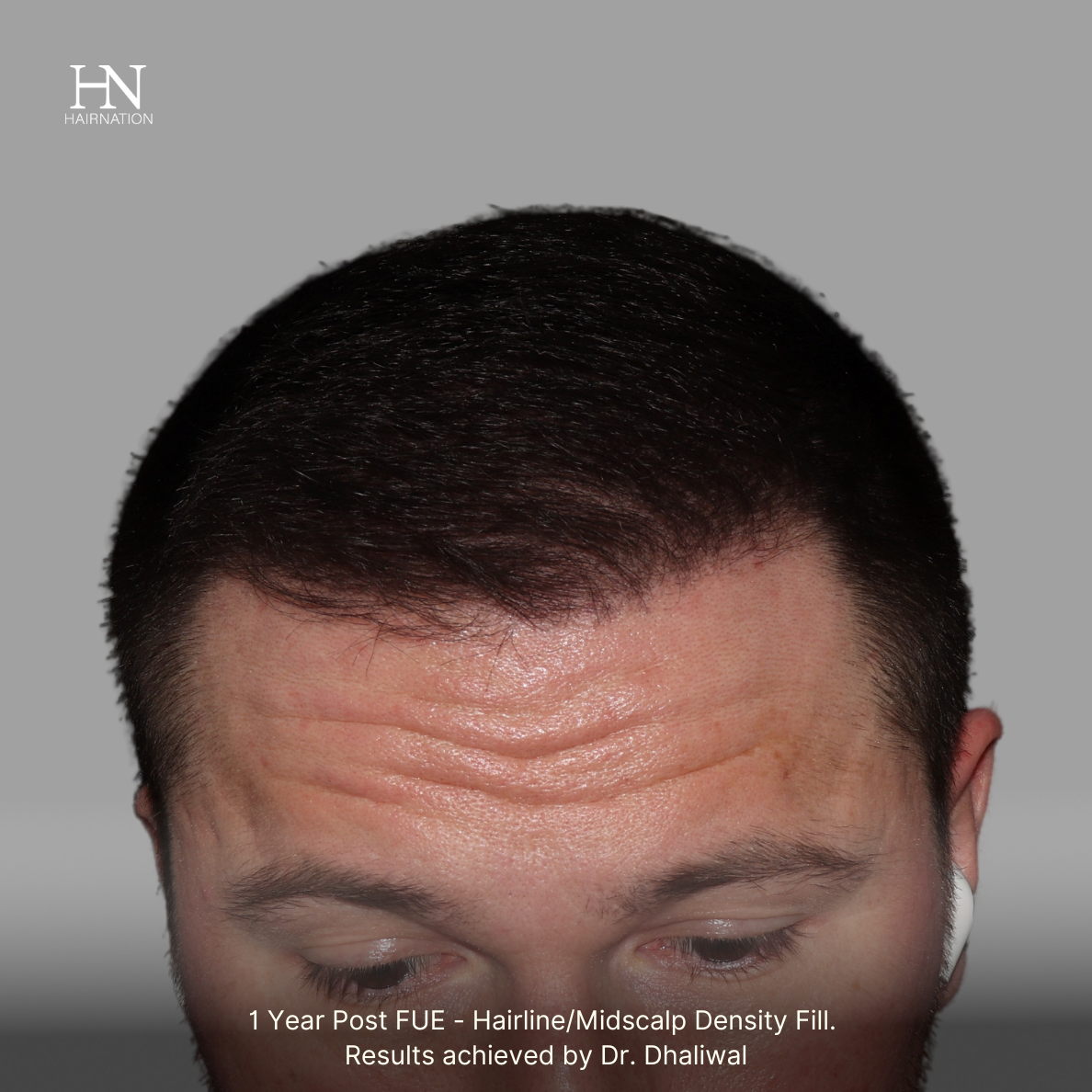 1 year post FUE - Before/After